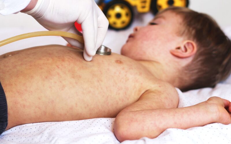 OMS face apel pentru vaccinarea copiilor împotriva rujeolei. Creștere fulminantă a numărului de cazuri în Europa