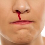 Sângerarea nazală. Cât de corect este să stai pe spate, cu mâinile ridicate VIDEO