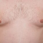 Ce este ginecomastia și cum poți scăpa de „sânii masculini”: „Pentru majoritatea bărbaților, problema există“