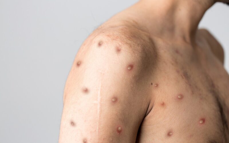 Vaccinurile împotriva variolei maimuței ar putea fi folosite pentru copii și adolescenți. Ce măsuri a luat China după alerta OMS