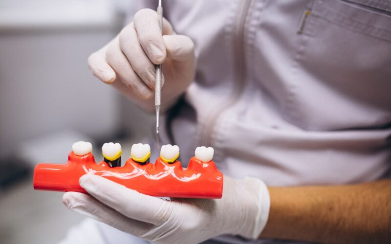 Poți beneficia de implant dentar dacă ai parodontoză?